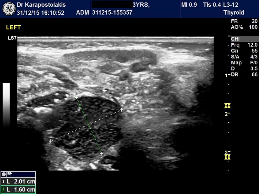 amygdalh Αμυγδαλές