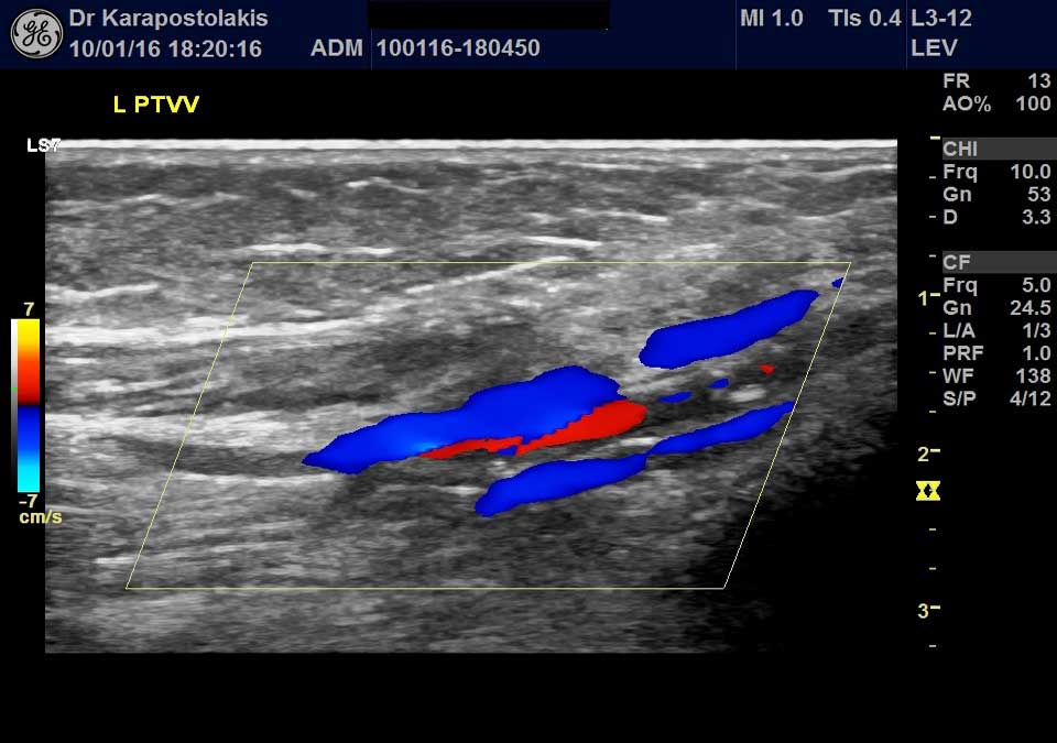 agia-podiou-enhlika Αγγεία ποδιού