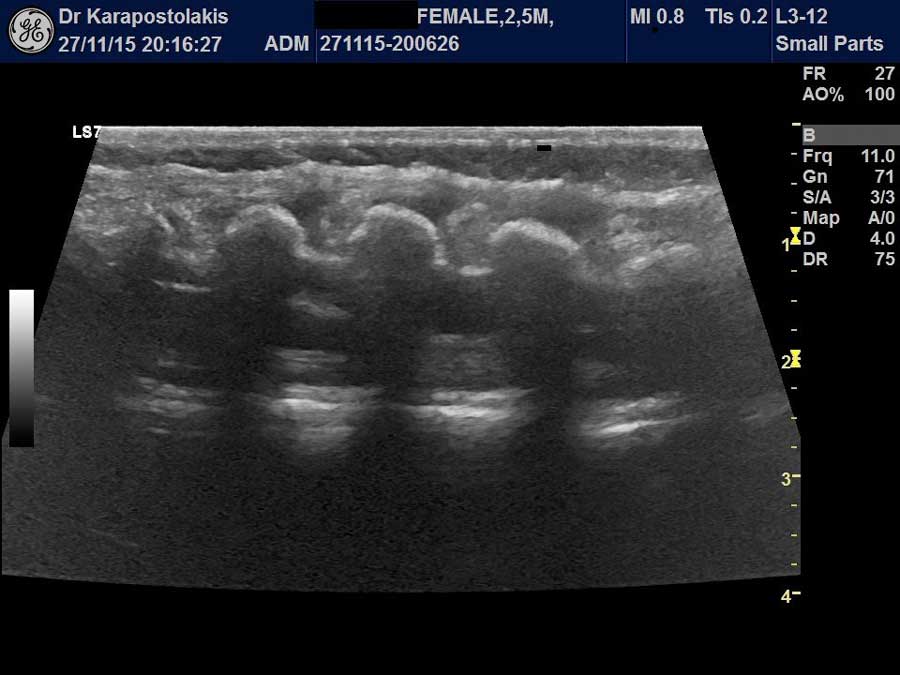 notieos-myelos Νωτιαίος μυελός