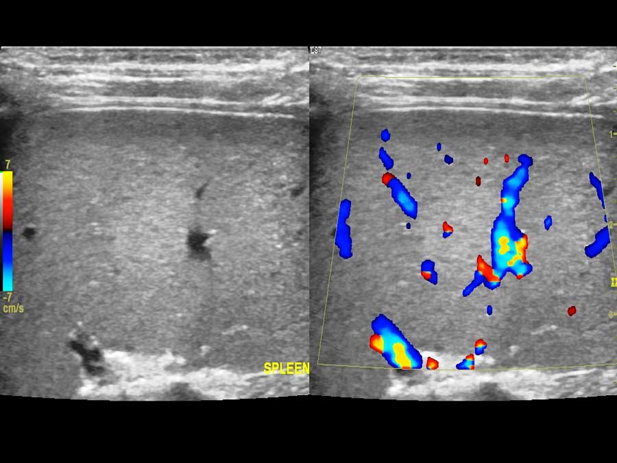 splhnas-paidi Σπλήνας
