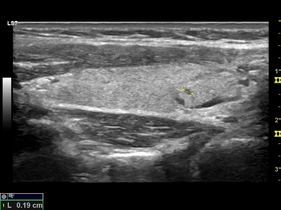 thyroidis θυροειδής